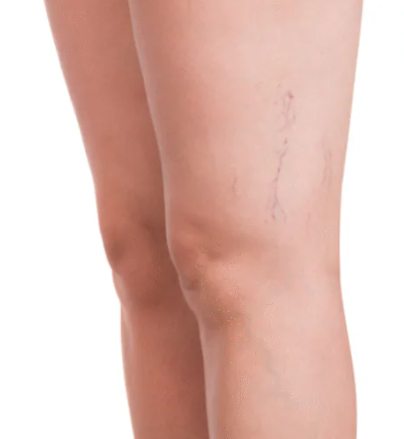 Skin before Hydrafacial treatment