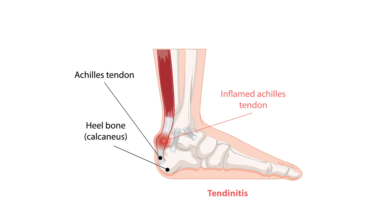 Physiotherapy for Tendinitis