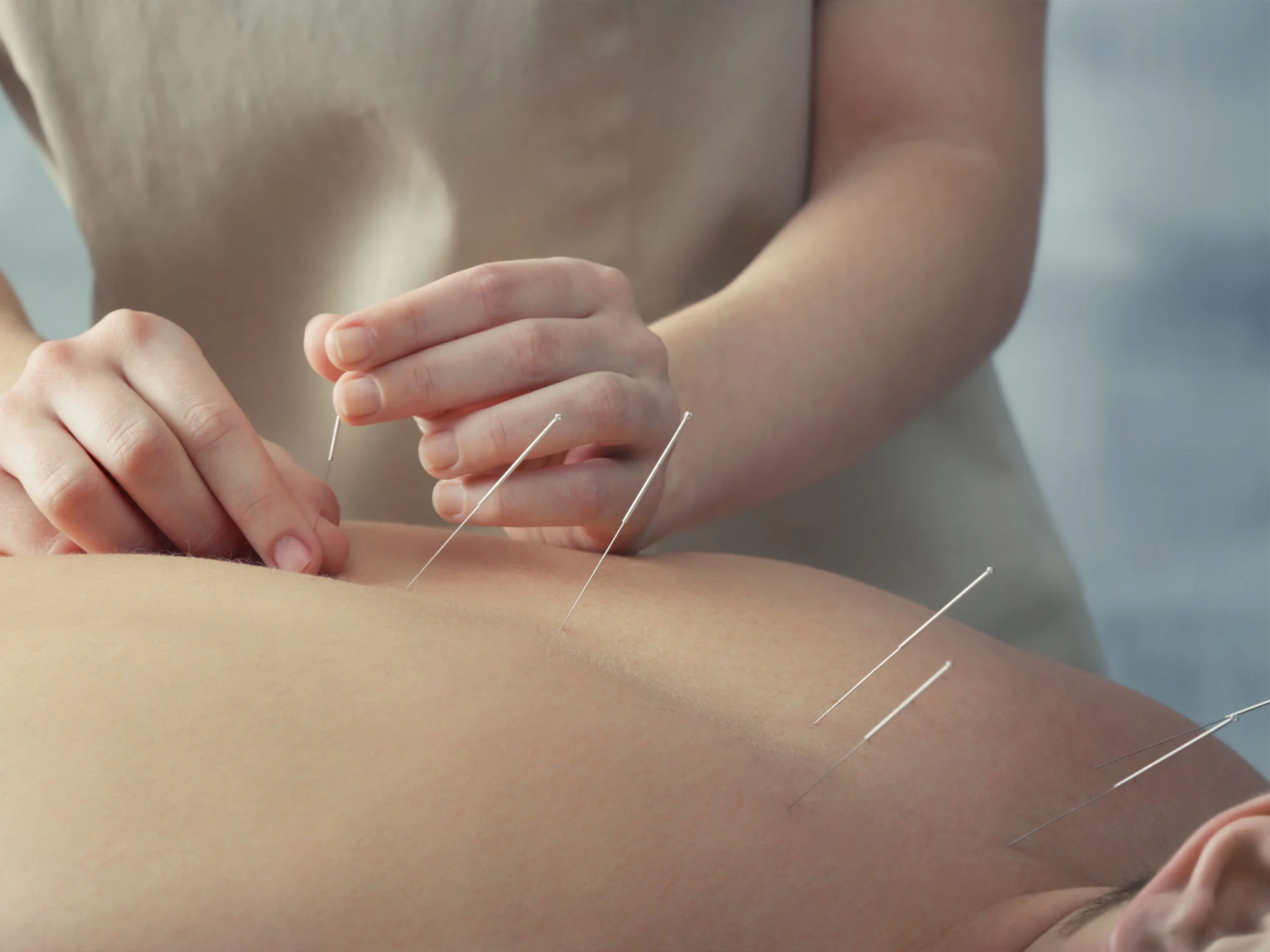 Bio Medical Dry Needling