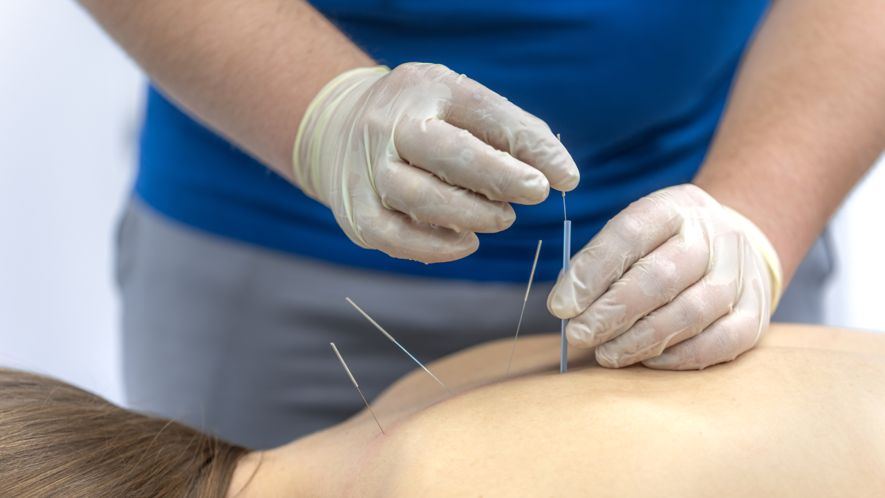 Acupuncture