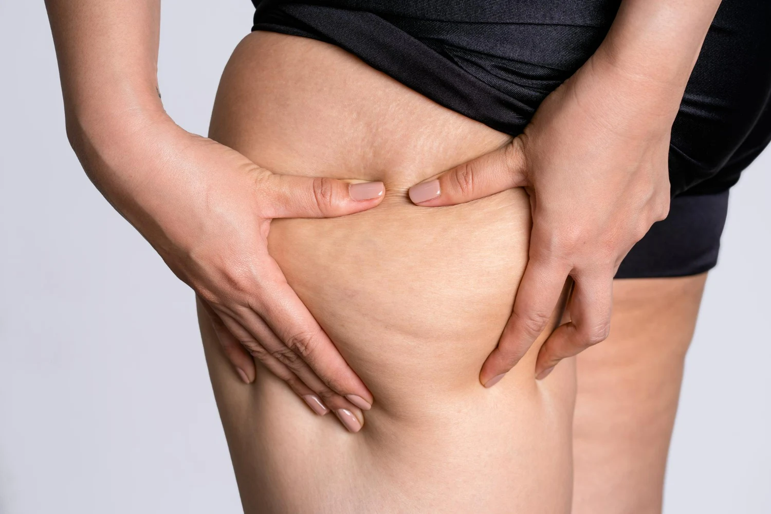 Lipedema